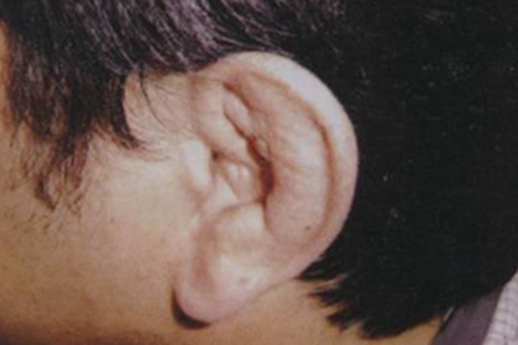 萎缩性多软骨炎耳廓肿图 萎缩性多软骨炎耳廓肿图