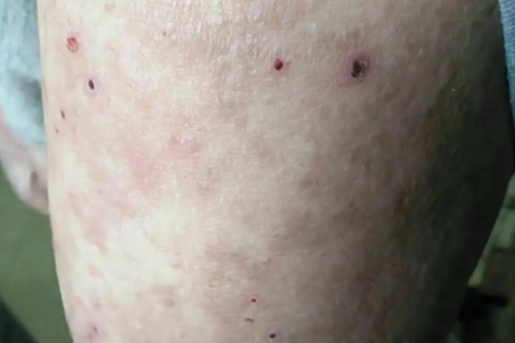 蕈样肉芽肿红斑期萎缩性斑片图 蕈样肉芽肿红斑期萎缩性斑片图