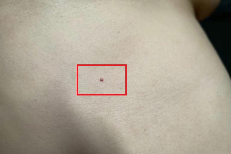 樱桃状血管瘤手腕症状图 樱桃状血管瘤手腕症状图