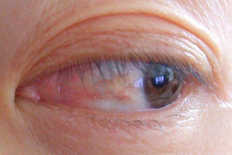 睑裂斑症状图