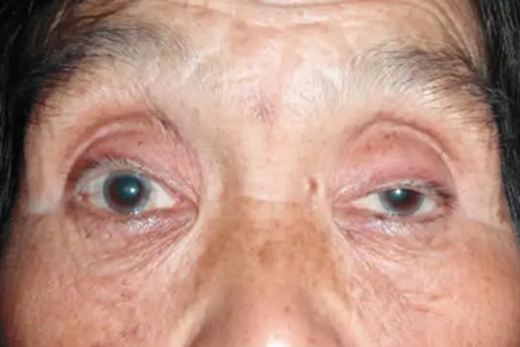 单纯性甲状腺肿眼睑下垂图