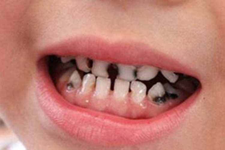 低龄儿童龋门牙有黑斑图