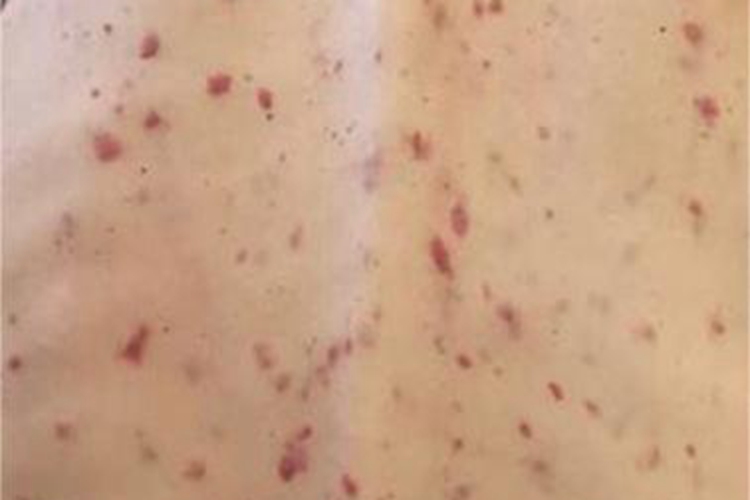 卡波西肉瘤背部症状图 卡波西肉瘤背部症状图