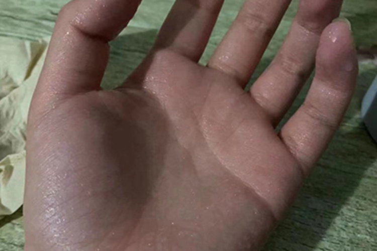 手汗症患者手部汗滴图 手汗症患者手部汗滴图