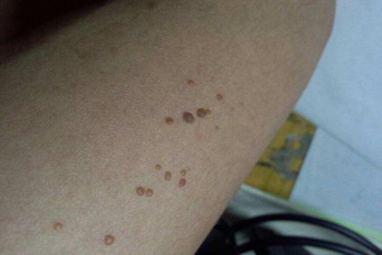 皮内痣大腿丘疹图 皮内痣大腿丘疹图