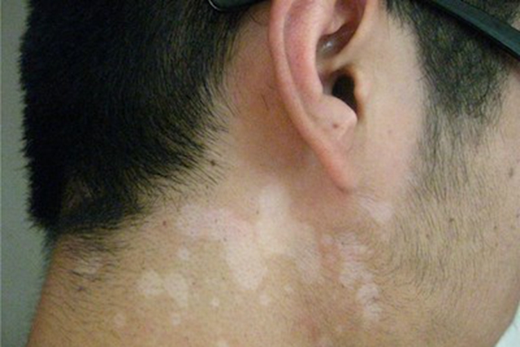 梅毒性白斑症状图