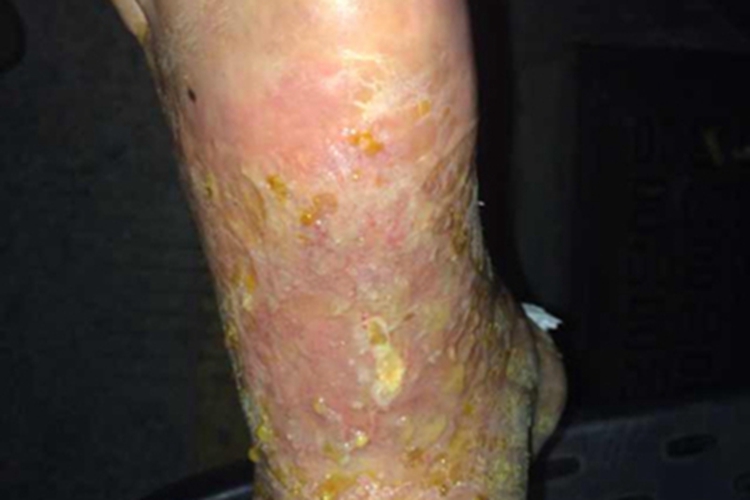 脓疱病脚背症状图 脓疱病脚背症状图