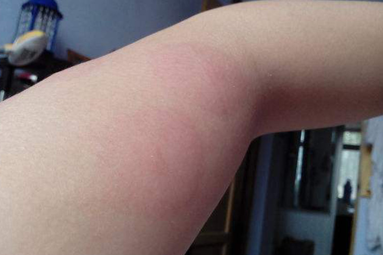 红色风团孤立存在症状图