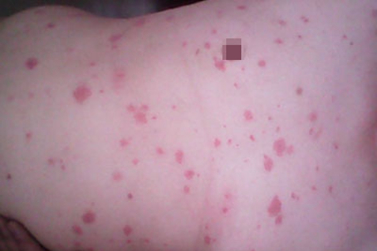 感染性荨麻疹胸部症状图 感染性荨麻疹胸部症状图