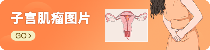 子宫肌瘤图片