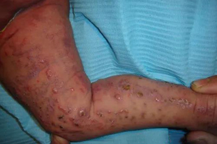 色素失调症腿水疱图 色素失调症腿水疱图