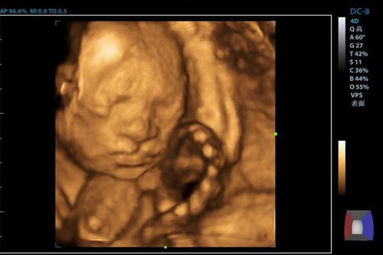 四维彩超唇裂胎儿图