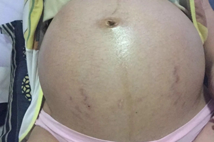 萎缩纹肚子下部有紫色条纹图