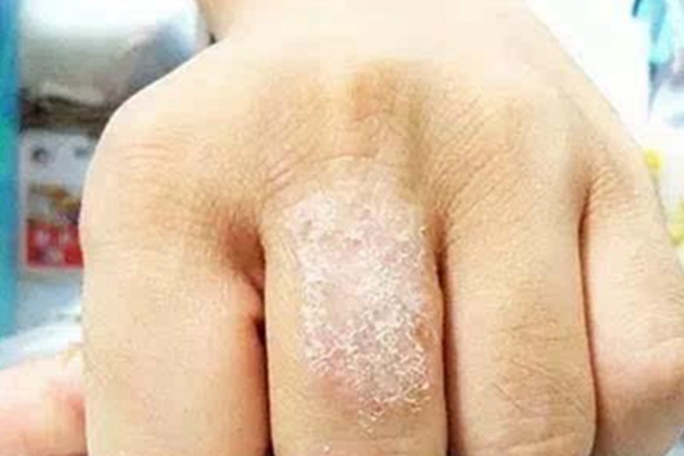 手部湿疹中指起白色鳞屑图