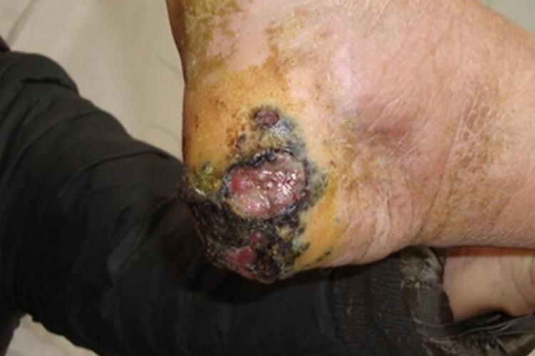 肢端雀斑痣样黑素瘤脚后跟结痂图