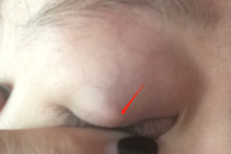 霰粒肿上眼皮小肿块图