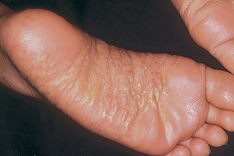 足癣脚底横纹图 足癣脚底横纹图