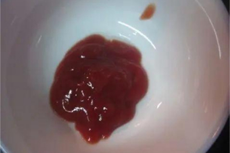 血吸虫病脓血便图 血吸虫病脓血便图