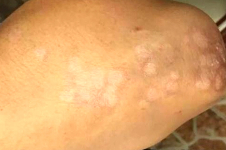 银屑病手背圆形白斑图