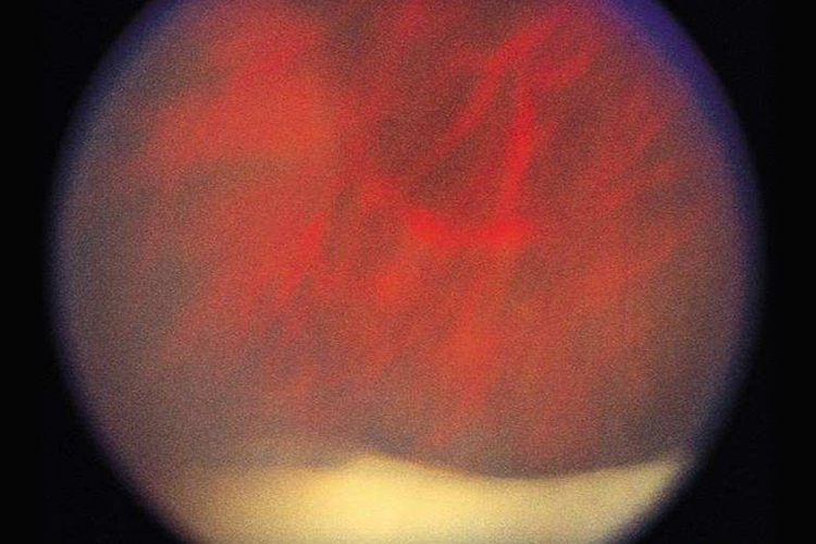 中间葡萄膜炎初期眼底图