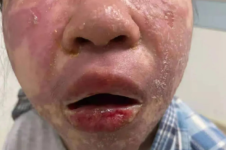 中毒性表皮坏死嘴唇糜烂图 中毒性表皮坏死嘴唇糜烂图