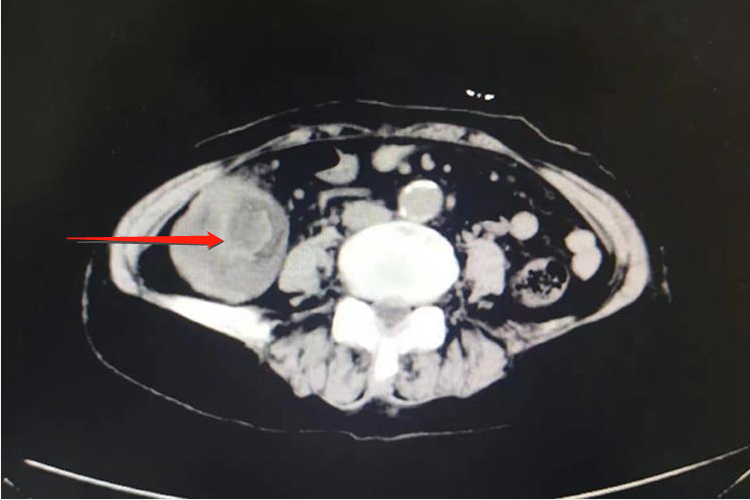 老年肠套叠CT图