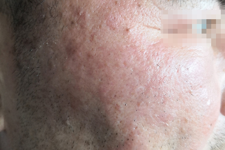 丹毒面部水肿性红斑图