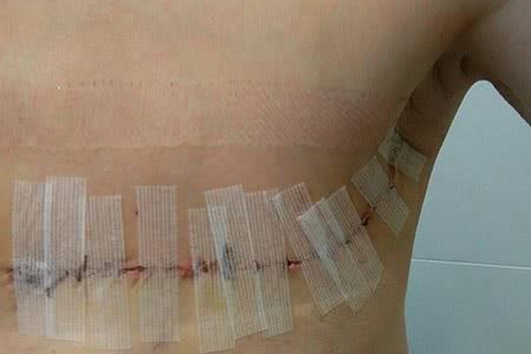 全乳切除手术后横向瘢痕图 全乳切除手术后横向瘢痕图