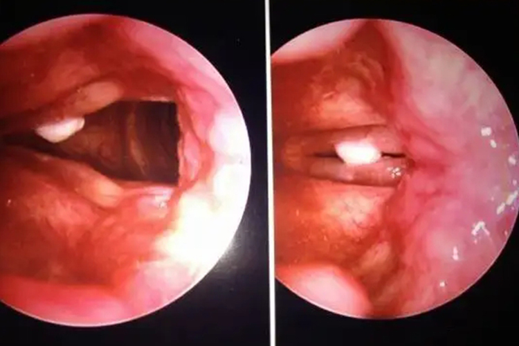 声带白斑轻微图