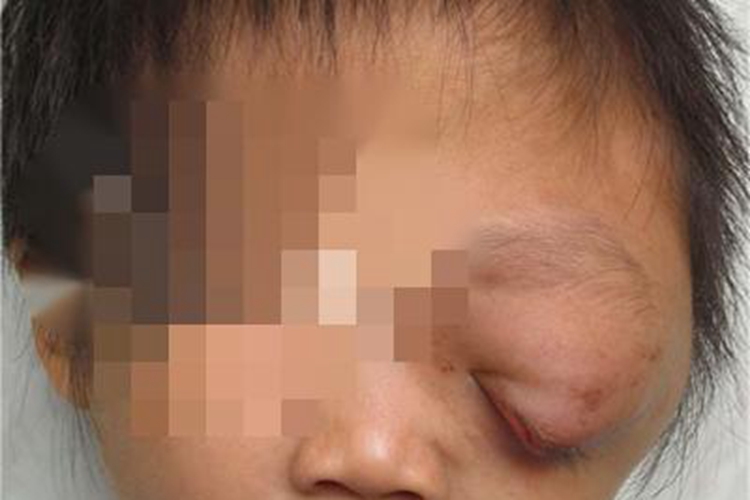 眼眶畸胎瘤眼部变形图