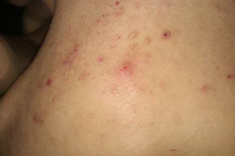 螨虫皮炎后颈症状图