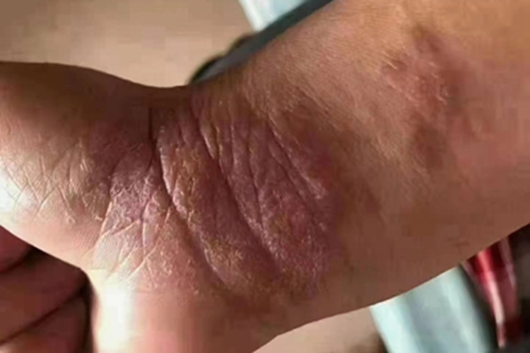 局限性神经性皮炎手腕红斑图