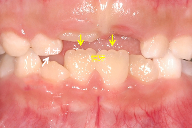儿童乳牙恒牙对比图 儿童乳牙恒牙对比图