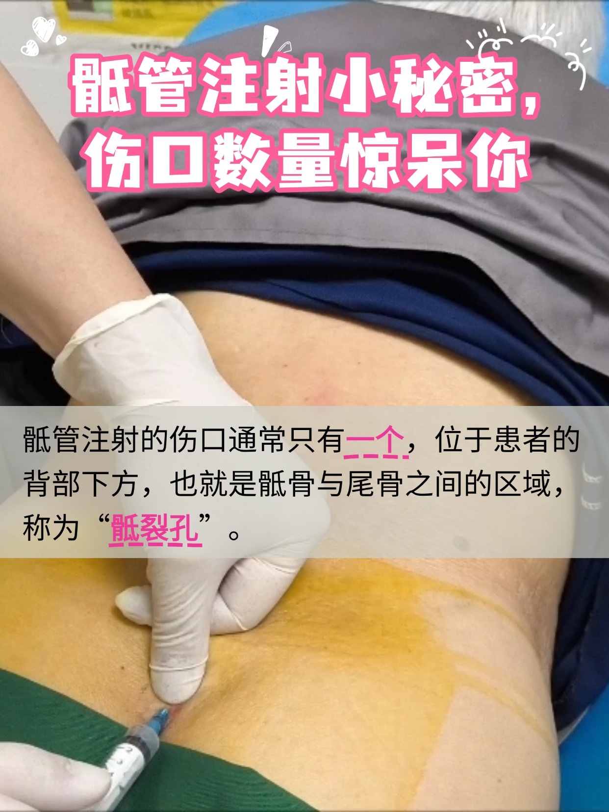 骶管注射小秘密，伤口数量惊呆你