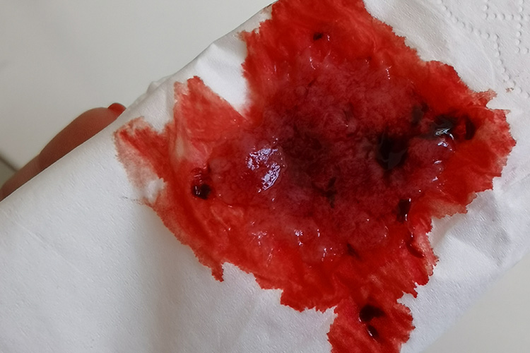 宫颈癌少量出血图片图片