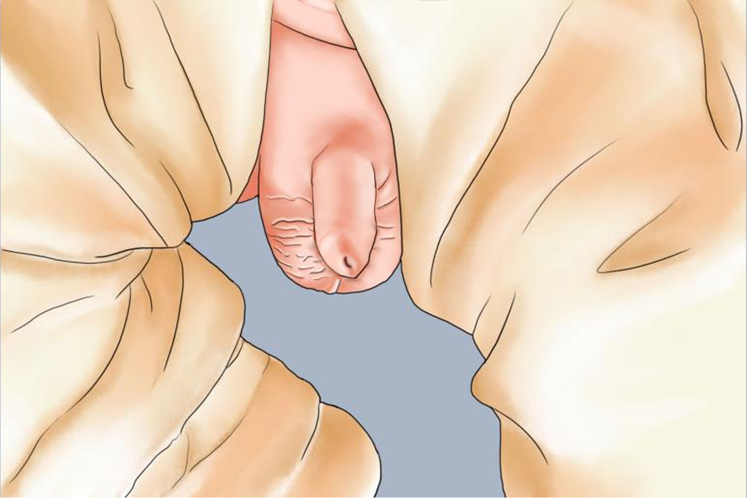 小孩正常包皮图