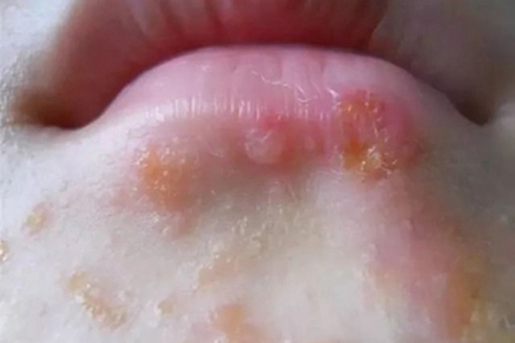 脓疱疮口周脓疱图