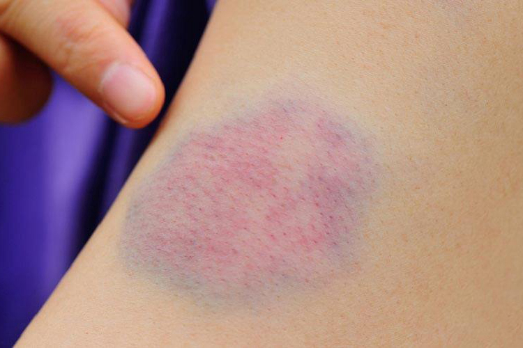 血小板减少皮肤淤斑图