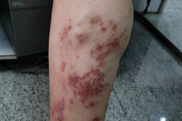 淤积性皮下硬化症硬包图 淤积性皮下硬化症硬包图