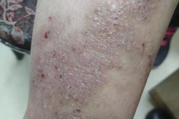 瘙痒症皮肤增厚图 瘙痒症皮肤增厚图