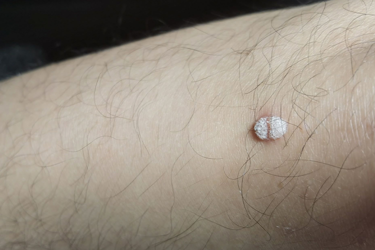 感染HPV病毒寻常疣图