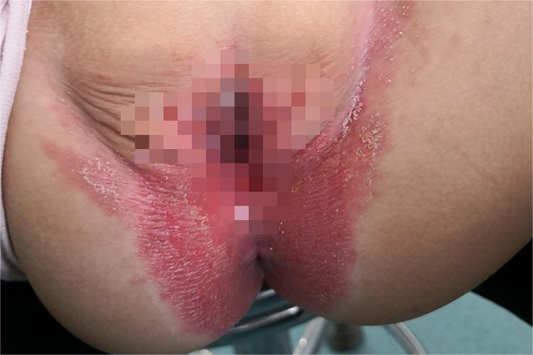 肛门湿疹图 肛门湿疹图