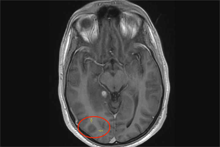 结核球MRI影像学表现图 结核球MRI影像学表现图