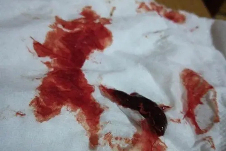 排卵期出血果冻状血块图