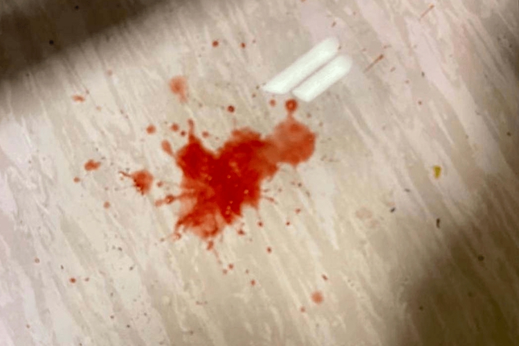 腹型过敏性紫癜呕血图