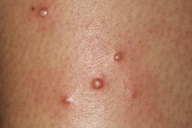 腿上毛囊炎长脓包图