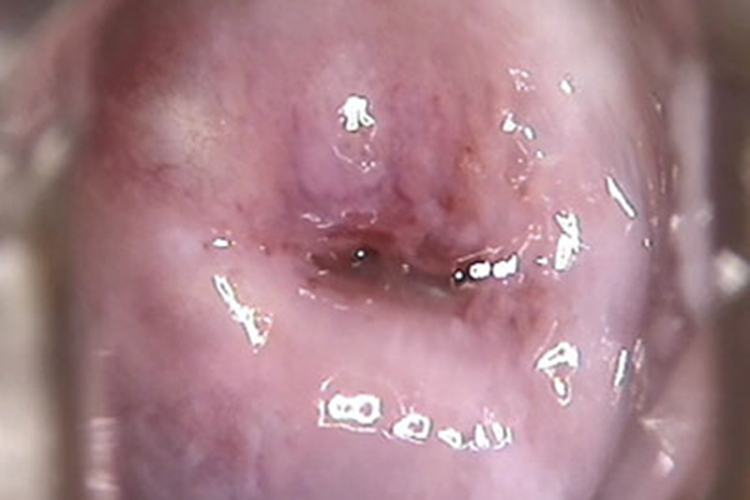 宫颈囊肿宫颈肥大肿胀图 宫颈囊肿宫颈肥大肿胀图