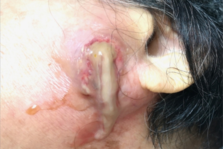 急性化脓性腮腺炎糜烂图 急性化脓性腮腺炎糜烂图