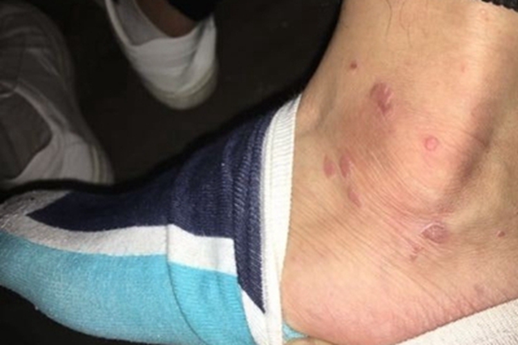 扁平疣脚踝丘疹图