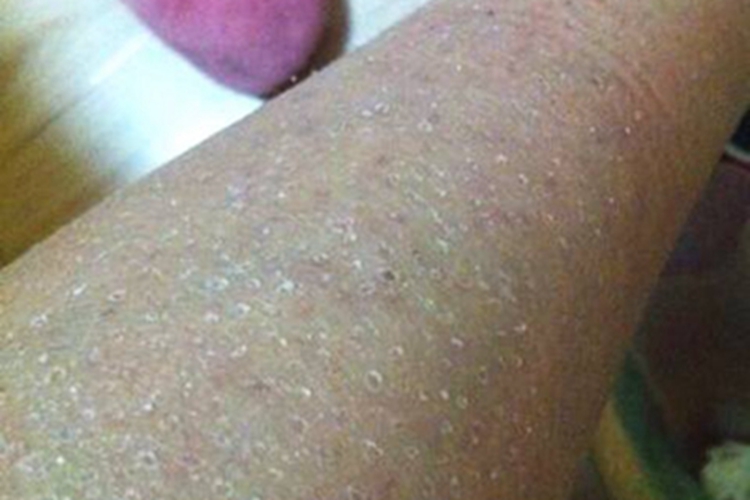 皮肤干燥症小腿脱皮斑图 皮肤干燥症小腿脱皮斑图